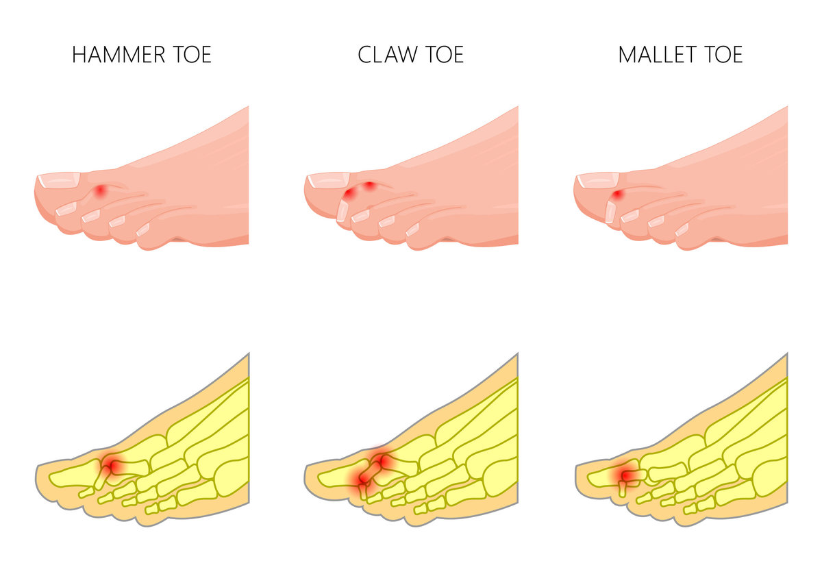 Surgical Non Surgical Treatment Options For Hammertoes The