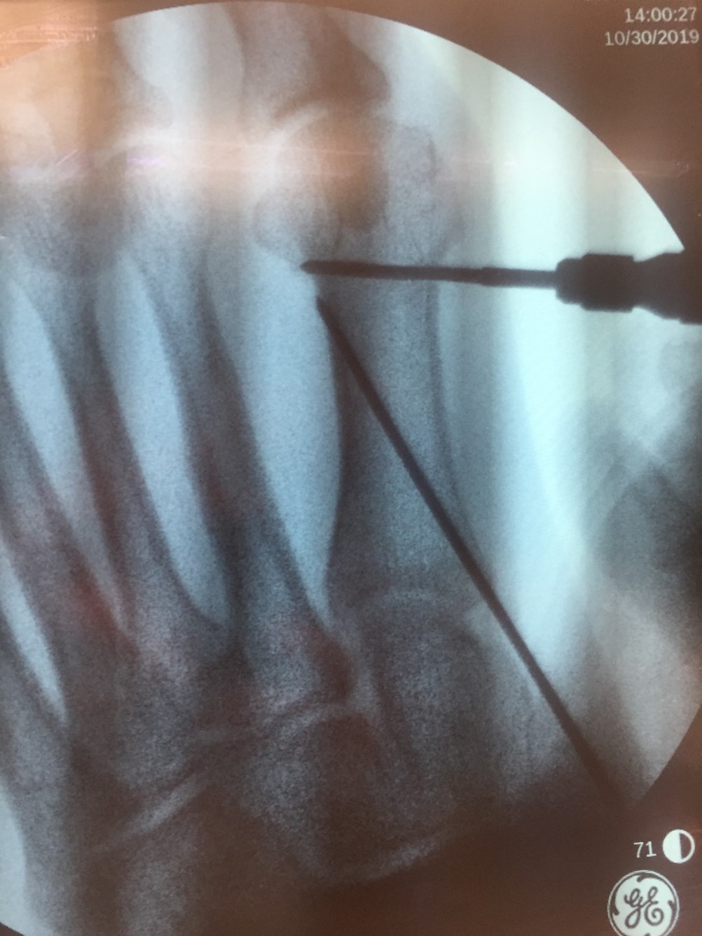 Burr in position to complete distal chevron osteotomy, with pre-positioned k-wire