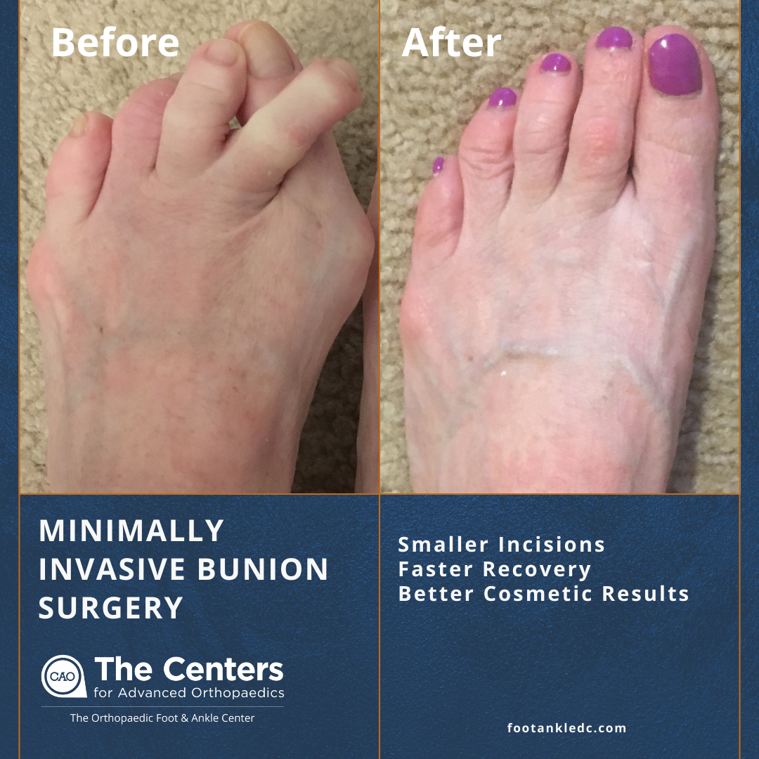 6 Options to Relieve Ingrown Toenail Pain at Home | Richardson Podiatry  Center