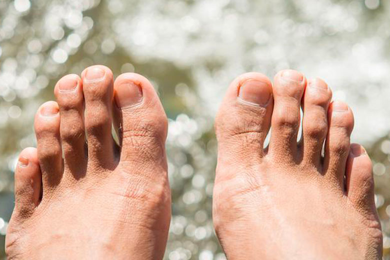 Hammertoes Specialist - Falls Church, VA & Arlington, VA