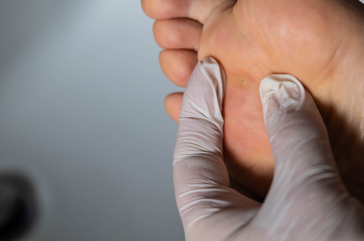 When Should You Visit A Specialist For Plantar Warts? The Orthopaedic