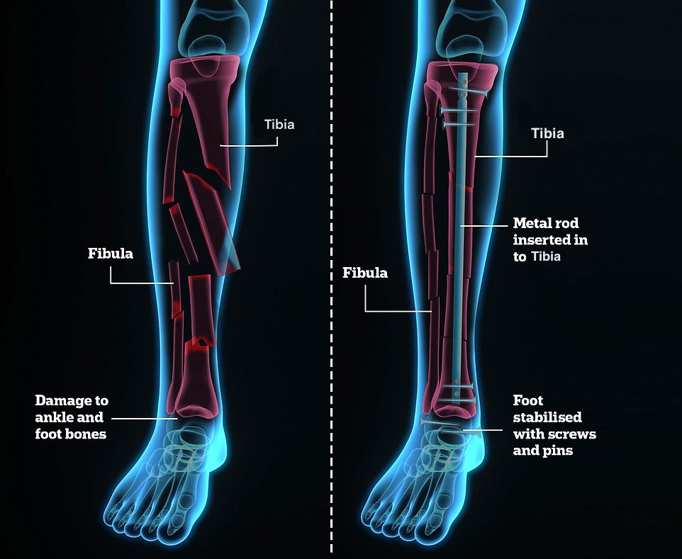 Tiger Woods Sustains Severe Injury to His Leg, Ankle & Foot - The  Orthopaedic Foot & Ankle Center