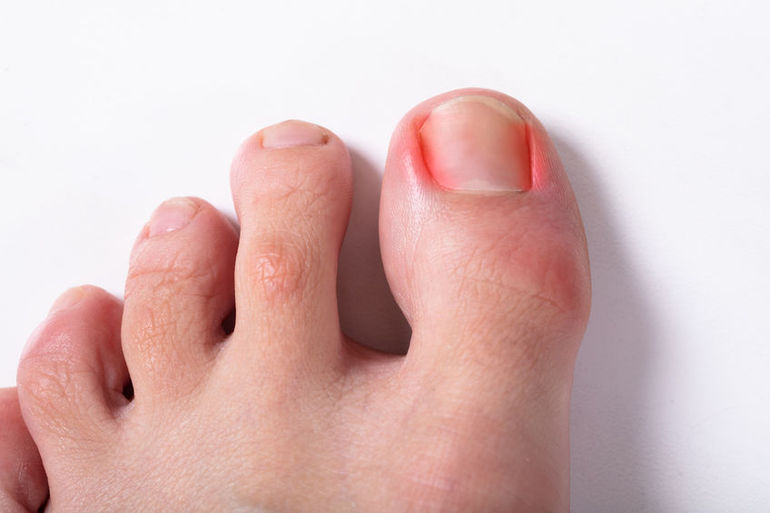 Why do I get Ingrown Toenails? Causes & Treatment Options - The