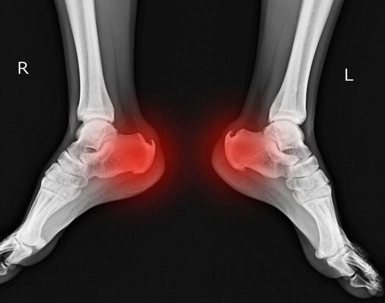 Calcaneal Stress Fracture | How to differentiate stress fractures from  other types of heel pain | MyFootShop.com