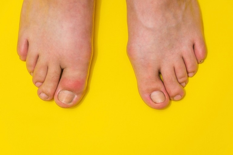 How To Treat Gout Of The Big Toe - The Orthopaedic Foot & Ankle Center