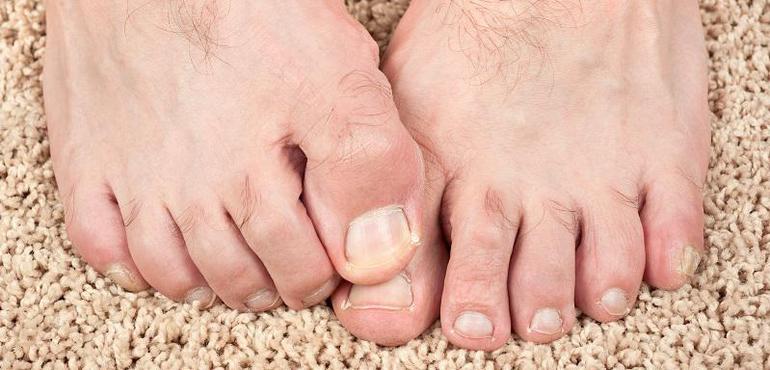Big Toe Joint Exercises To Restore Movement After Bunion Surgery